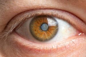 Close up of eye with cataract