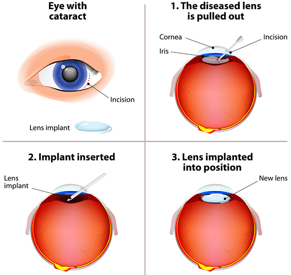 Steps laser cataract surgery