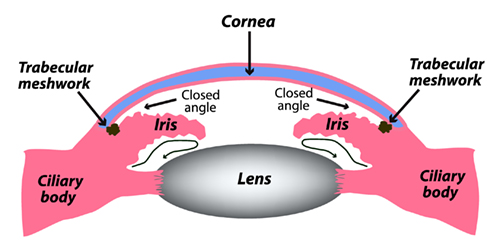 Illustration of Closed Angle Glaucoma
