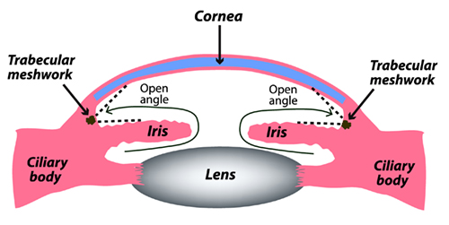 Illustration of Open Angle Glaucoma